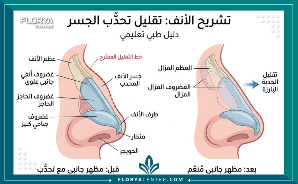 رسم توضيحي طبي يظهر تشريح الأنف ويوضح كيفية التخلص من البروز العظمي في جراحة الأنف الصقري.