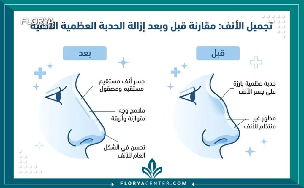 إنفوجرافيك يقارن شكل الأنف قبل وبعد عملية إزالة حدبة الأنف العظمية وتجميل الجسر.
