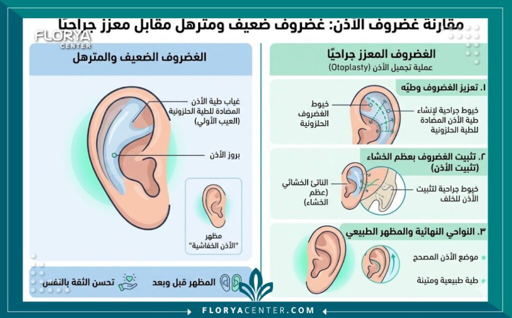 إنفوجرافيك يقارن بين حالة الأذن المرتخية قبل جراحة تثبيت الأذن المرتخية جراحياً وبعد تقوية الغضروف وتثبيته جراحياً في الخشاء.