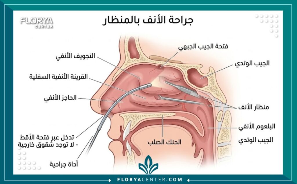 رسم توضيحي طبي لتشريح الأنف يوضح طريقة إجراء عملية تجميل الأنف المغلقة عبر شقوق داخلية مخفية.