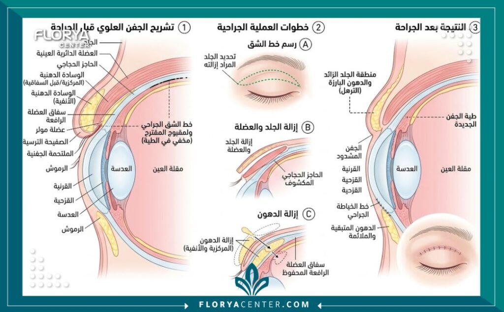 رسم توضيحي طبي دقيق يشرح تشريح العين وخطوات إزالة الجلد والدهون الزائدة في عملية قص الجفون العلوية الكلاسيكية.