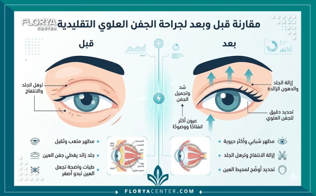 إنفوجرافيك يقارن بين شكل العين المتدلية قبل العملية والنتيجة المشدودة بعد إجراء جراحة تجميل الجفن العلوي التقليدية.