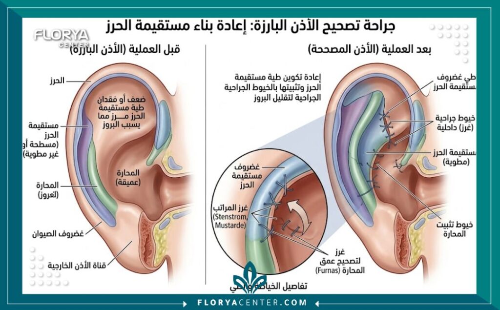 رسم توضيحي طبي يشرح تشريح غضروف الأذن وخطوات طي الغضروف في جراحة ترميم الأذن الخفاشية.