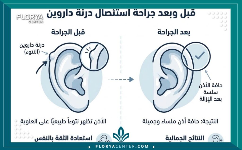 جراحة تصحيح أذن داروين 3 إنفوجرافيك يقارن بين شكل الأذن قبل وبعد عملية إزالة بروز أذن داروين وتسوية الغضروف.