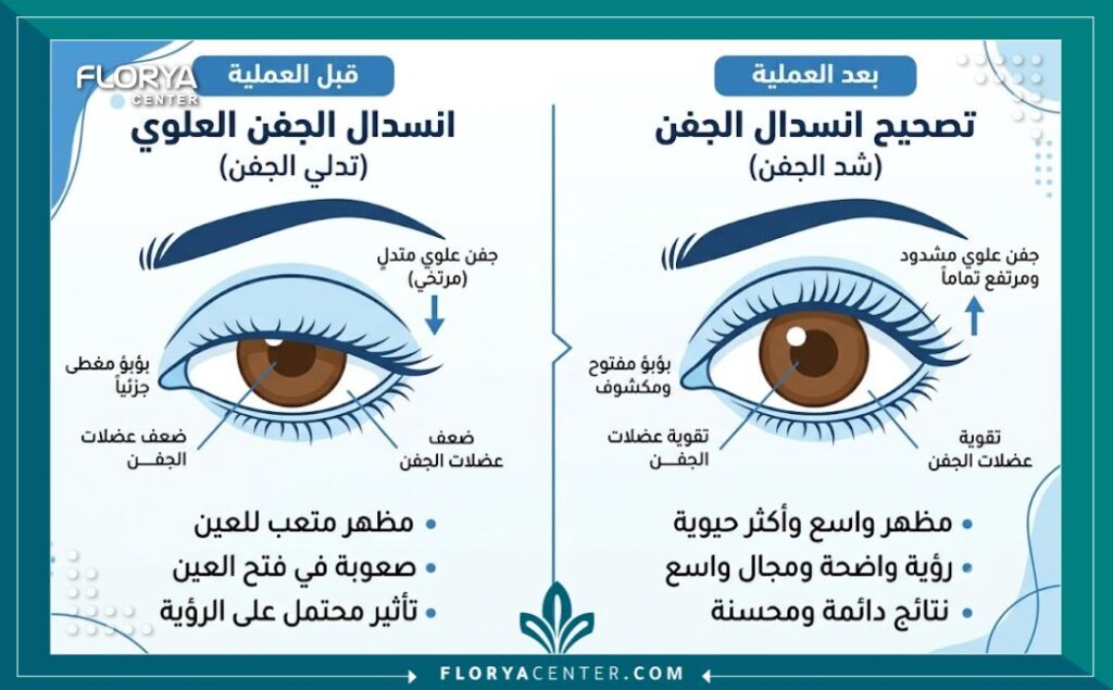 إنفوجرافيك يقارن بين شكل العين قبل وبعد عملية شد العضلة الرافعة و جراحة تصحيح ارتخاء الجفن العلوي.