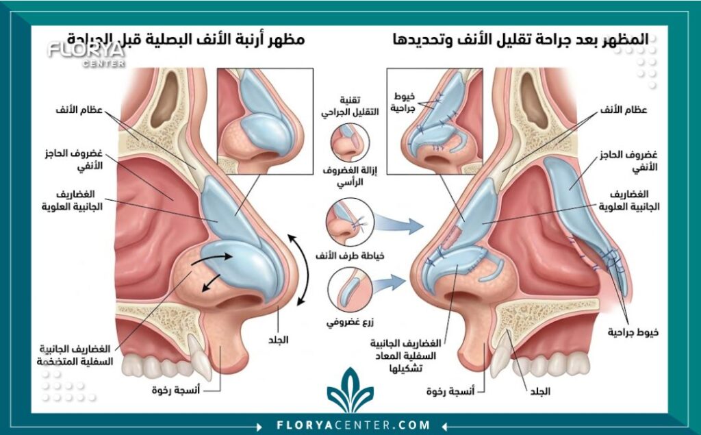 رسم توضيحي طبي يظهر تشريح غضاريف الأنف وكيفية إجراء جراحة تصغير أرنبة الأنف البصلية.