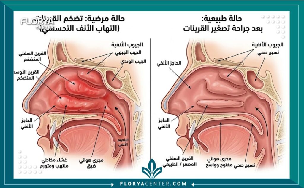 رسم طبي يوضح تشريح تجويف الأنف والفرق قبل وبعد عملية تصغير القرينات الأنفية المتضخمة.
