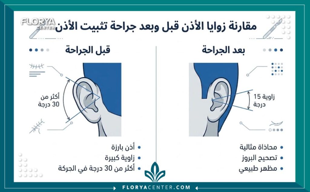 جراحة تعديل زاوية الأذن ع الرأس 3 إنفوجرافيك يقارن بين زاوية الأذن البارزة والنتيجة المثالية لزاوية الأذن بعد عملية التجميل.