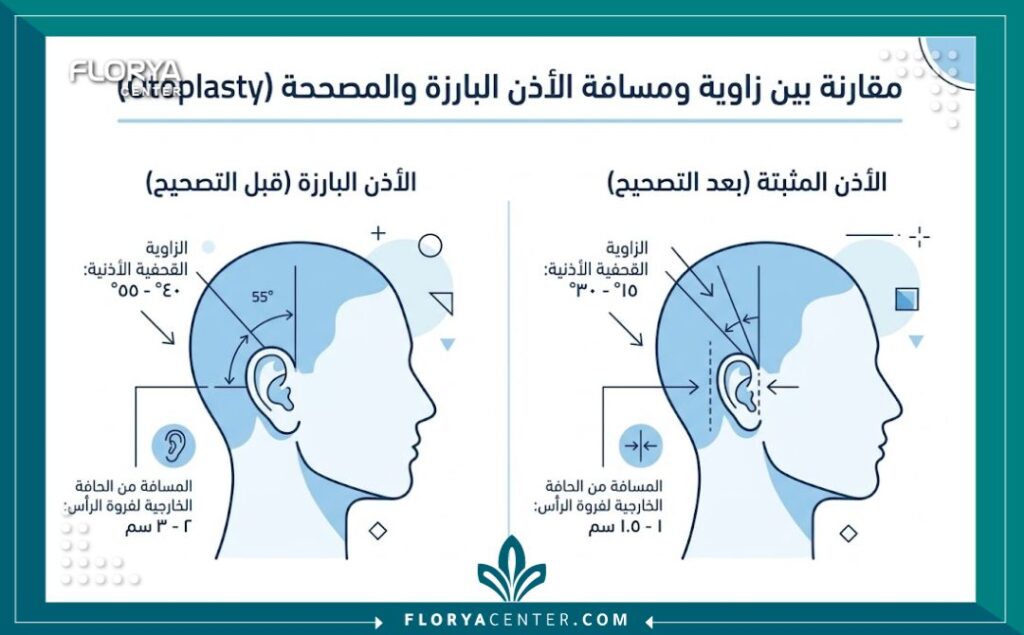 جراحة زاوية الاذن مع الراس 3 إنفوجرافيك يوضح مقارنة الزوايا والمسافة بين الأذن والرأس قبل وبعد جراحة زاوية الاذن مع الراس.