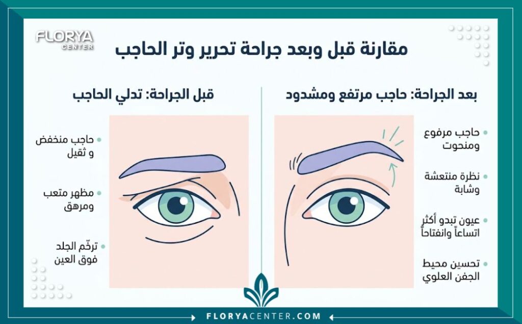 إنفوجرافيك يوضح الفرق قبل وبعد عملية تحرير ورفع الحاجب المتهدل جراحياً.