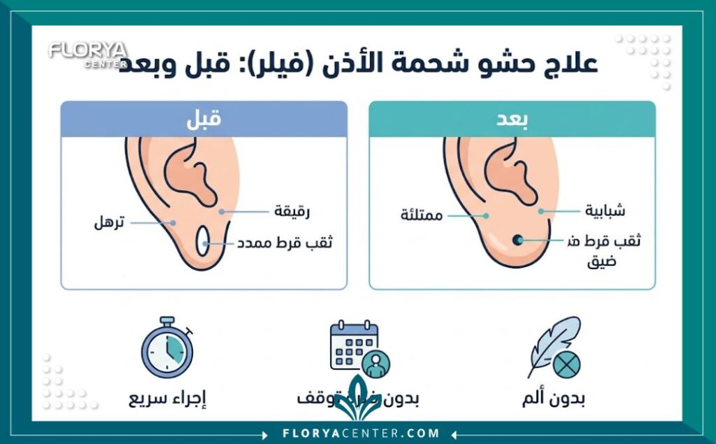إنفوجرافيك طبي يقارن بين شكل شحمة الأذن قبل وبعد الفيلر مع توضيح مميزات وفوائد الإجراء التجميلي.