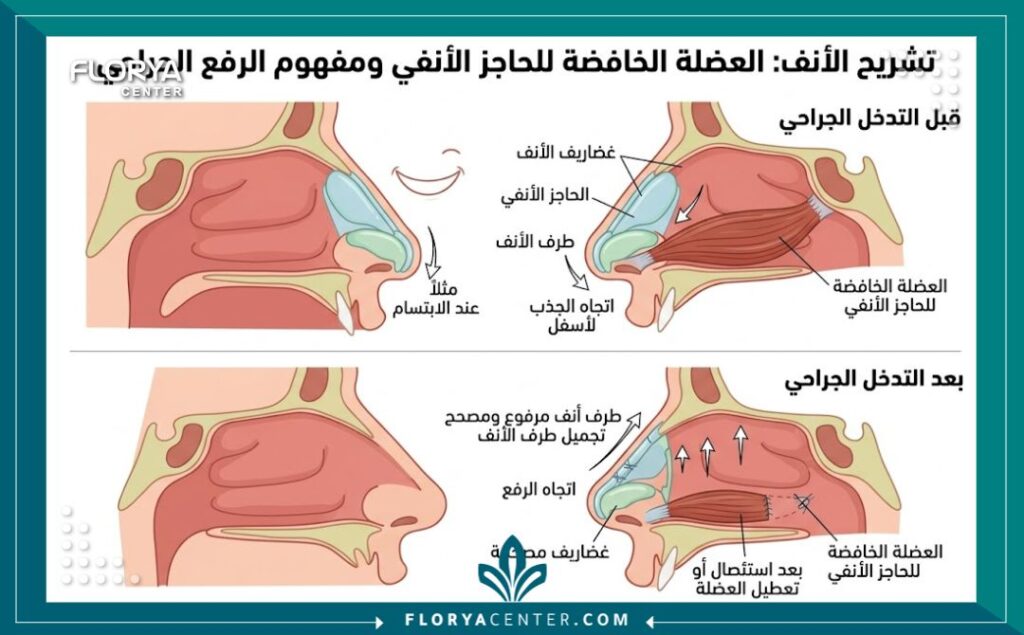 رفع أرنبة الأنف المتدلية جراحياً 2 رسم توضيحي طبي لتشريح الأنف يوضح غضاريف الأرنبة وعضلة الابتسام المسؤولة عن هبوط الأنف.