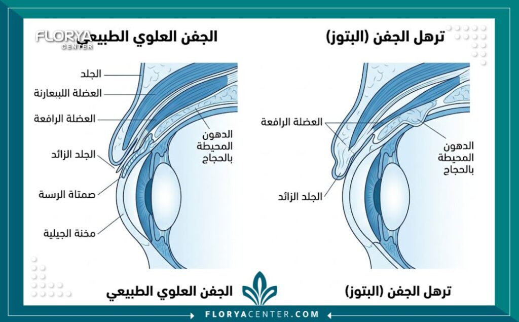 رفع الجفون المتهدلة في تركيا 1 - رفع الجفون المتهدلة في تركيا يعاني الكثيرون من مظهر العيون المرهقة، لكن عملية رفع الجفون المتهدلة في تركيا (Blepharoplasty) تقدم حلاً جذرياً. يحول التدخل الطبي الدقيق الأنسجة المترهلة لعيون شابة، ويمثل مركز فلوريا المعيار الذهبي لضمان نتائج طبيعية وآمنة.
