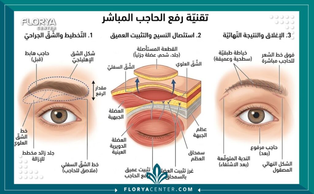 رفع الحواجب عبر شق جراحي مباشر 2 رسم توضيحي طبي يبين موقع استئصال الجلد في عملية رفع الحواجب عبر شق جراحي مباشر أعلى الحاجب.