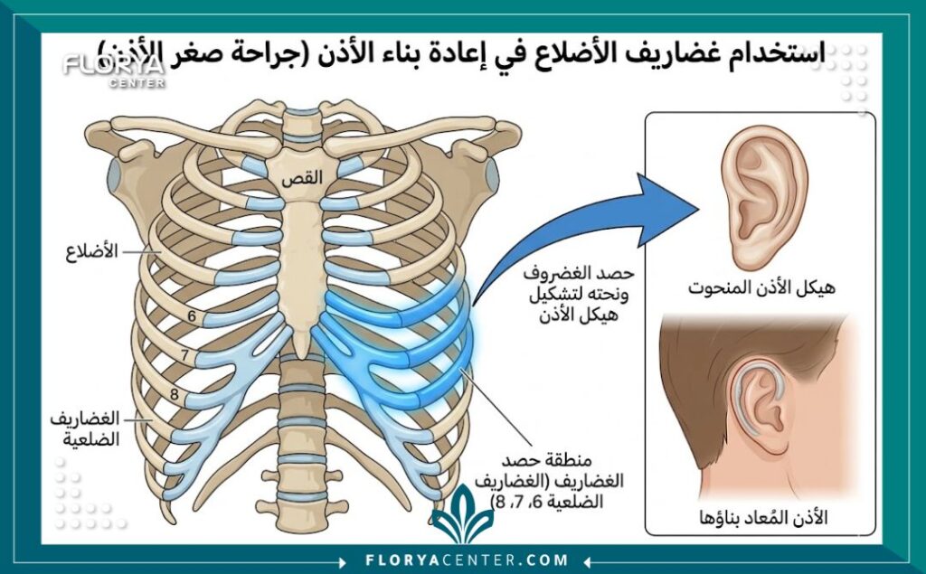 رسم توضيحي طبي مفصل يشرح التشريح الهندسي لأخذ غضروف الضلع من القفص الصدري لتشكيل أذن جديدة في جراحات ترميم الأذن.