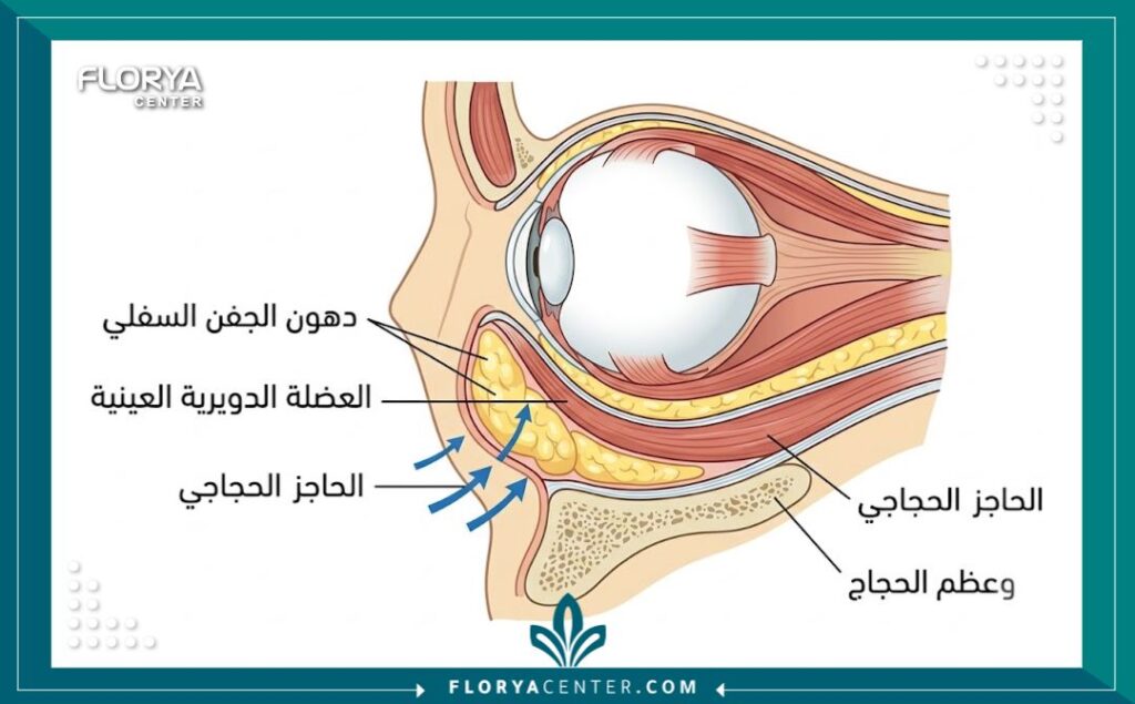 رسم تخطيطي طبي يوضح تشريح العين ومواقع الأكياس الدهنية في الجفن السفلي المستهدفة بالإزالة الجراحية.