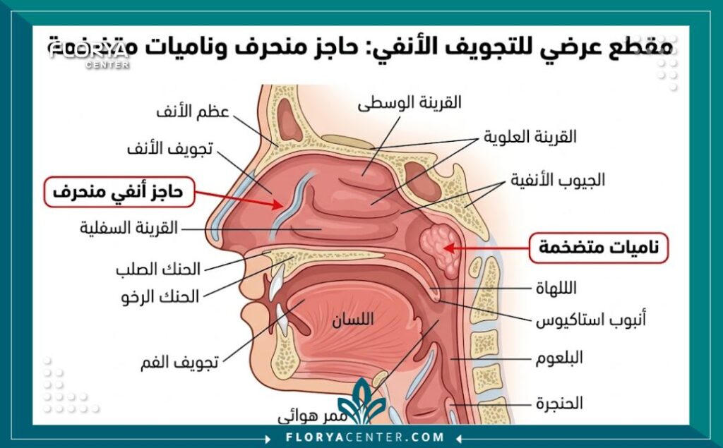 رسم توضيحي طبي يوضح تشريح انحراف الحاجز الأنفي وتضخم اللحمية وانسداد مجرى التنفس.