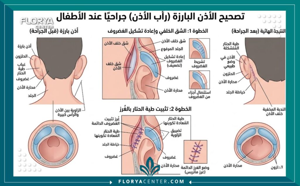 مخطط طبي توضيحي يشرح كيفية تعديل غضاريف الأذن في عملية تجميل الأذن للأطفال.