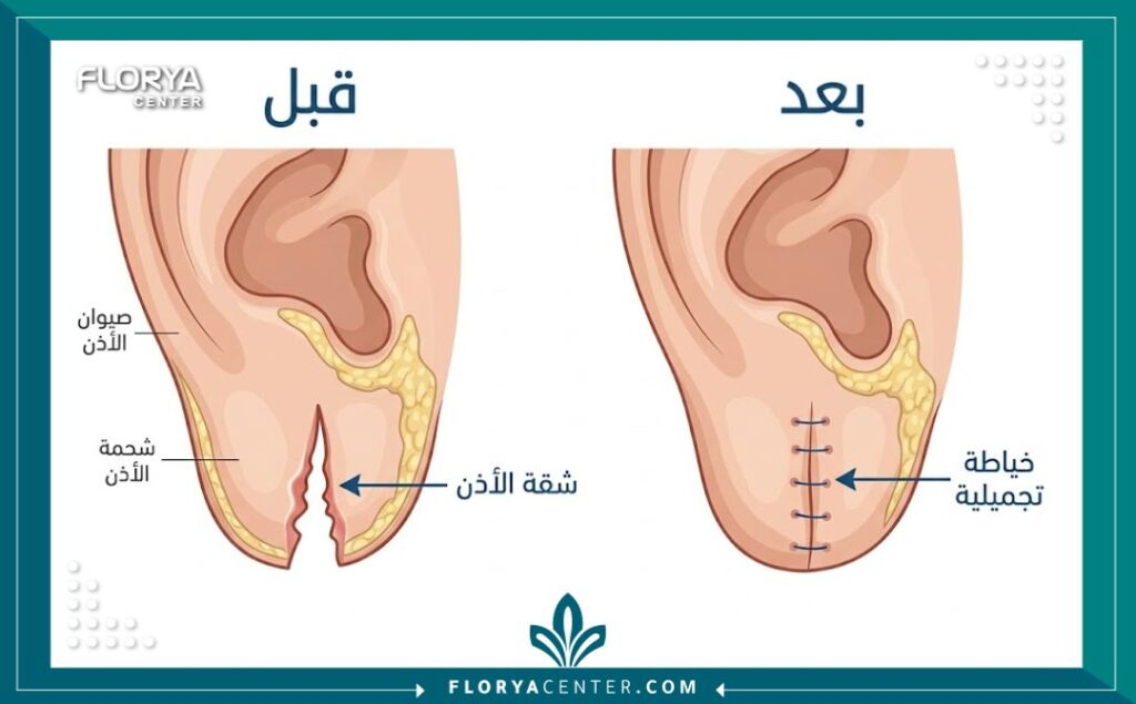 رسم تخطيطي طبي يوضح خطوات خياطة وترميم شحمة الأذن الممزقة بالتفصيل
