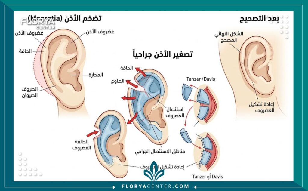 مخطط طبي يوضح كيفية قص وتصغير غضروف الأذن الكبيرة أثناء العملية الجراحية.
