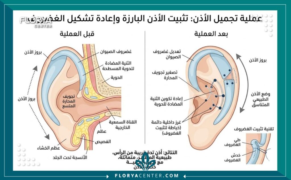 رسم توضيحي طبي يوضح خطوات عملية تجميل الأذن البارزة في تركيا