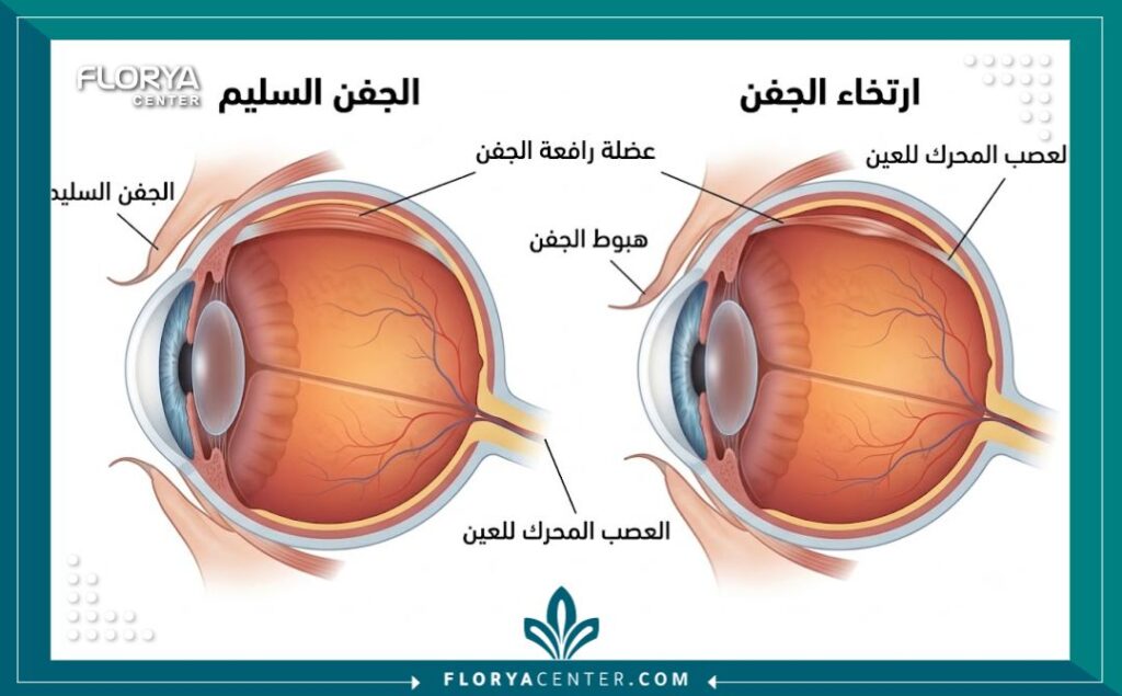رسم توضيحي طبي يبين التشريح الداخلي لارتخاء الجفن (البتوسيس) ومقارنته بالجفن السليم، موضحًا العضلات المتأثرة.