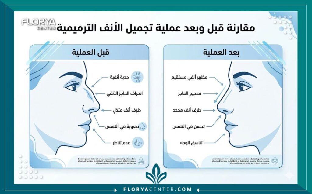 إنفوجرافيك يوضح مقارنة لخطوات ونتائج جراحة تجميل الأنف الخلقي في تركيا.