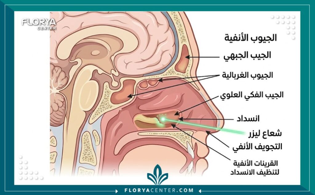 رسم توضيحي طبي يظهر تشريح الجيوب الأنفية وكيفية تسليط الليزر الدقيق لتنظيف الانسدادات بأمان.