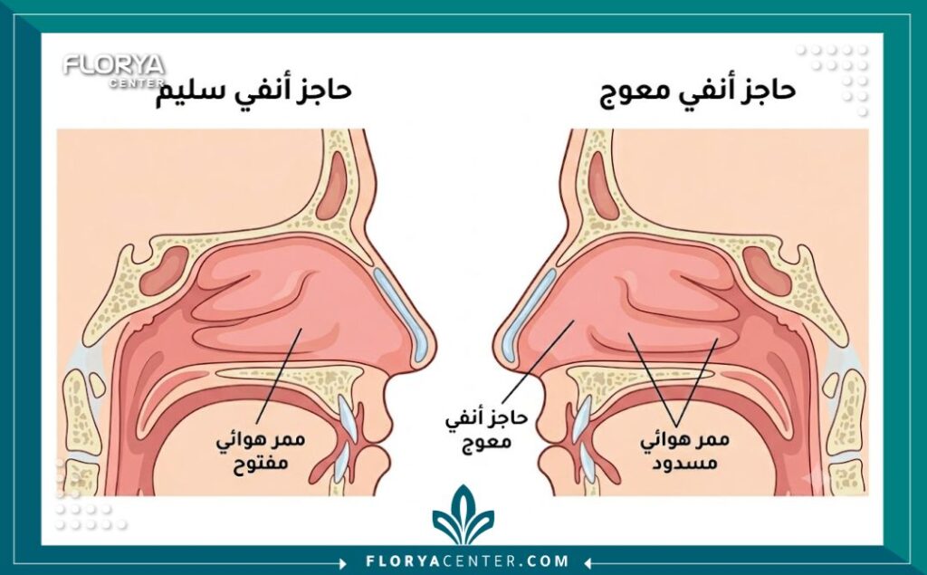 رسم بياني طبي يوضح الفرق بين الحاجز الأنفي المعوج والسليم وعلاجه في تركيا.