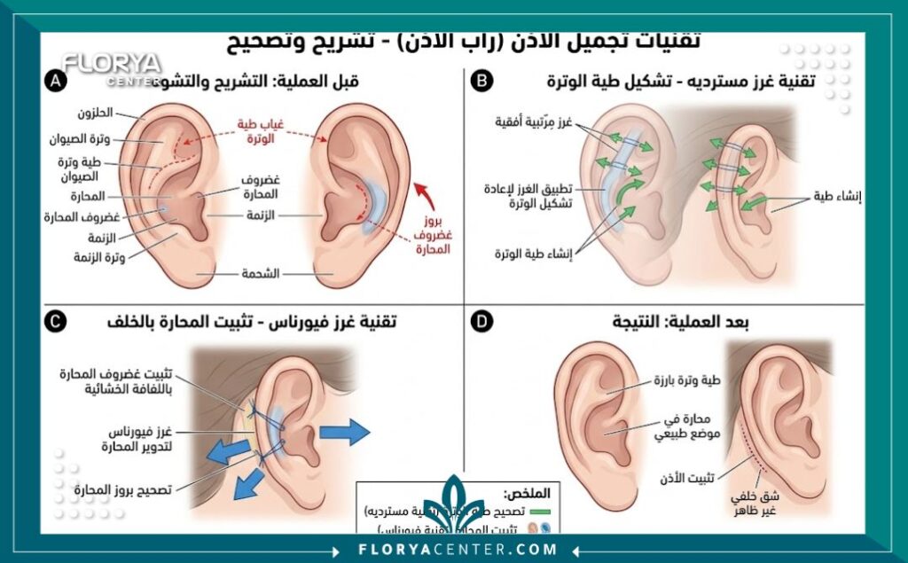 علاج بروز الأذن في تركيا 2 رسم توضيحي طبي مفصل يشرح تشريح غضروف الأذن وكيفية إجراء عملية تجميل الأذن البارزة وتصحيح طية الأذن.