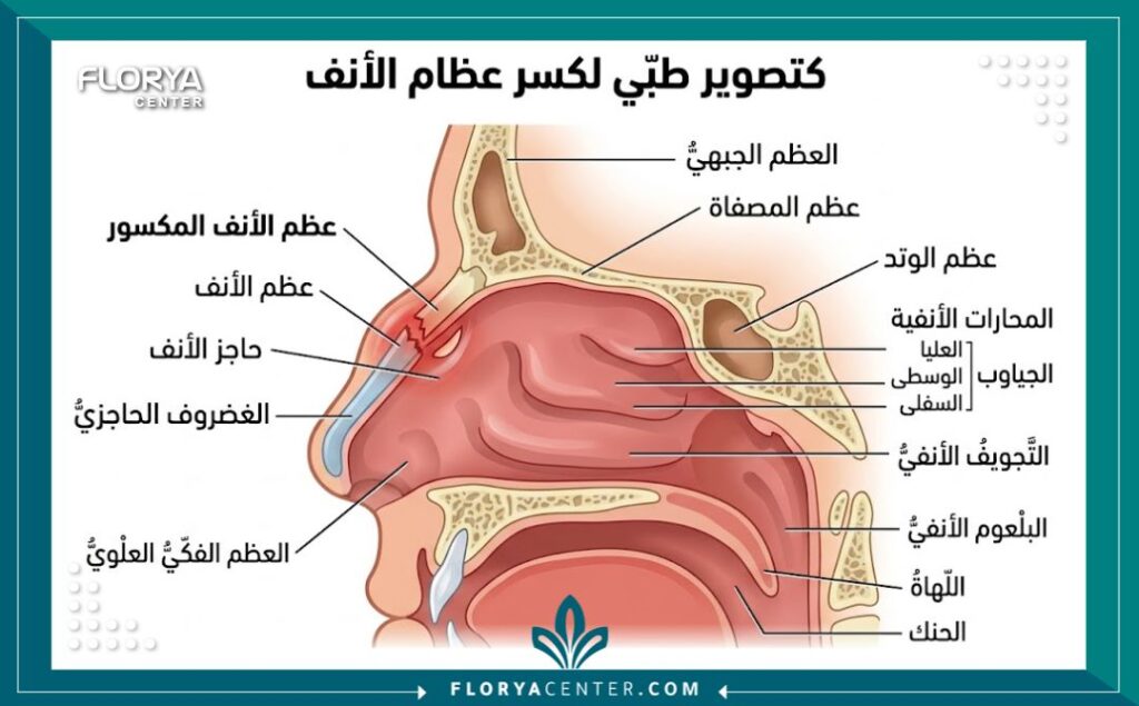 رسم توضيحي طبي يظهر تشريح عظام الأنف المكسور وكيفية تضرر الأنف بعد التعرض لصدمة مباشرة.