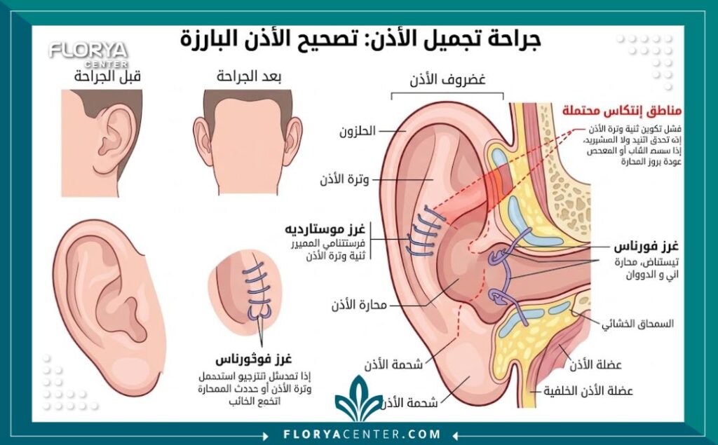 رسم توضيحي طبي يوضح غضروف الأذن وأماكن الغرز الجراحية لفهم أسباب رجوع الأذن البارزة وعلامات فشل العملية.