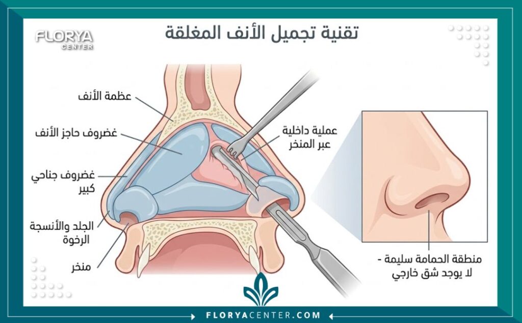 عمليات تجميل الأنف المغلقة في تركيا 2 رسم توضيحي طبي يشرح تشريح عملية تجميل الأنف المغلقة ويوضح عدم وجود شق جراحي خارجي أسفل الأنف.