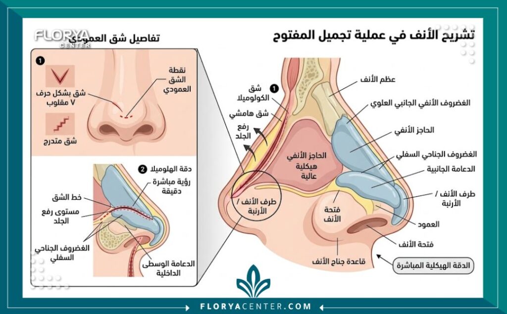 رسم توضيحي طبي يبين موقع الشق الخارجي في جراحة تجميل الأنف المفتوحة لضمان دقة التعديل الهيكلي.