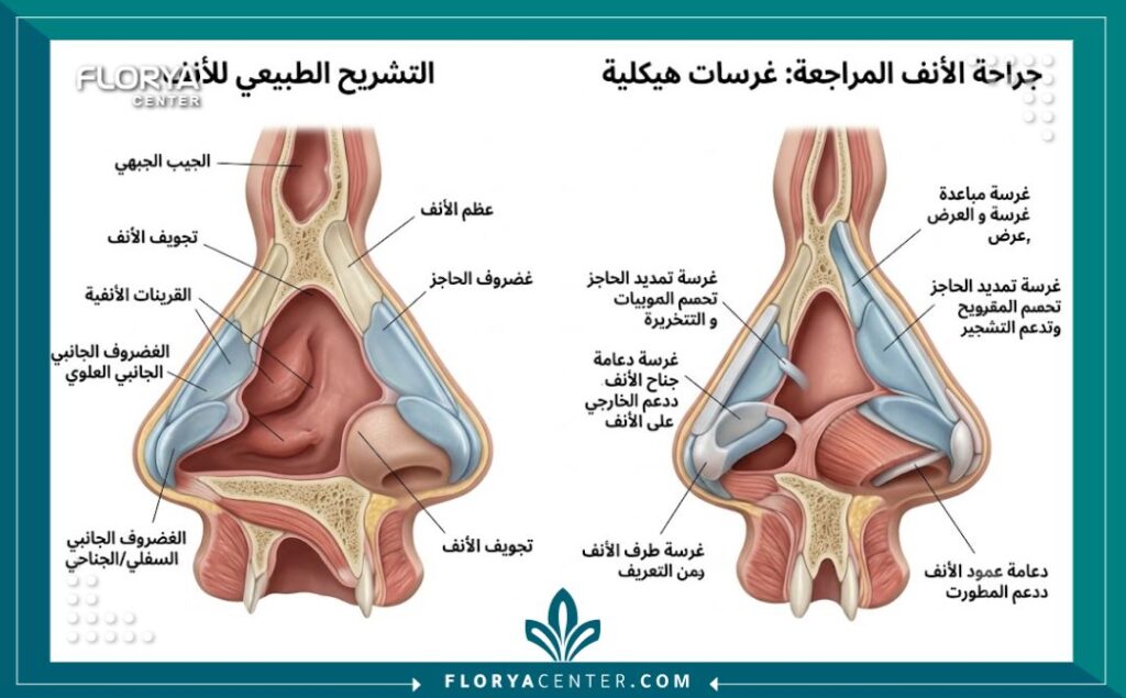 رسم توضيحي طبي مفصل يظهر تشريح الغضاريف وكيفية تدعيم هيكل الأنف خلال عملية تجميل الأنف الثانوية.