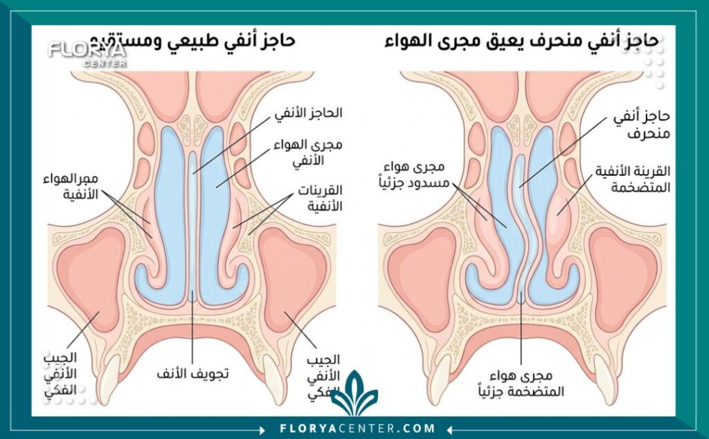 رسم توضيحي طبي يشرح تشريح الأنف والفرق بين الحاجز الأنفي الطبيعي وانحراف الوتيرة الأنفية الذي يسبب انسداد التنفس.