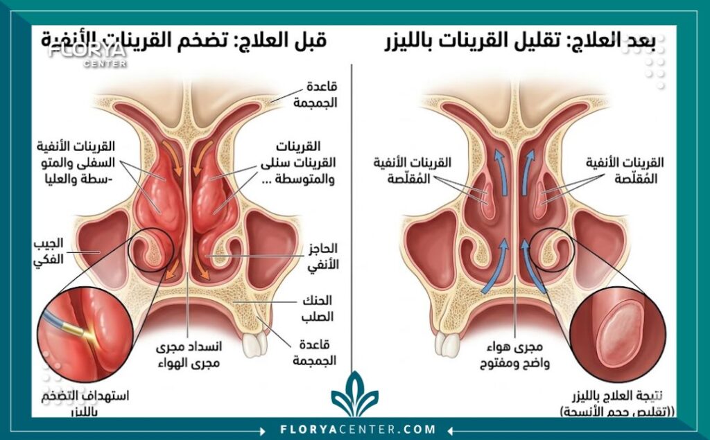 رسم توضيحي طبي يوضح تشريح الأنف وتضخم القرينات الأنفية قبل وبعد عملية التصغير
