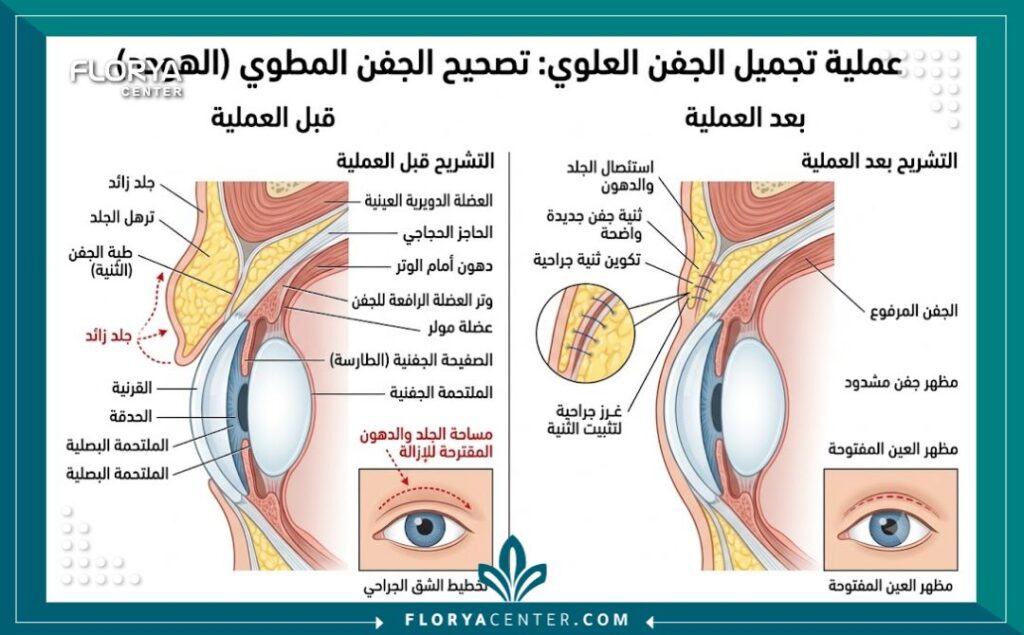 رسم توضيحي طبي يشرح تشريح الجفن العلوي وكيفية إزالة الجلد الزائد في عملية تبطينة العين.