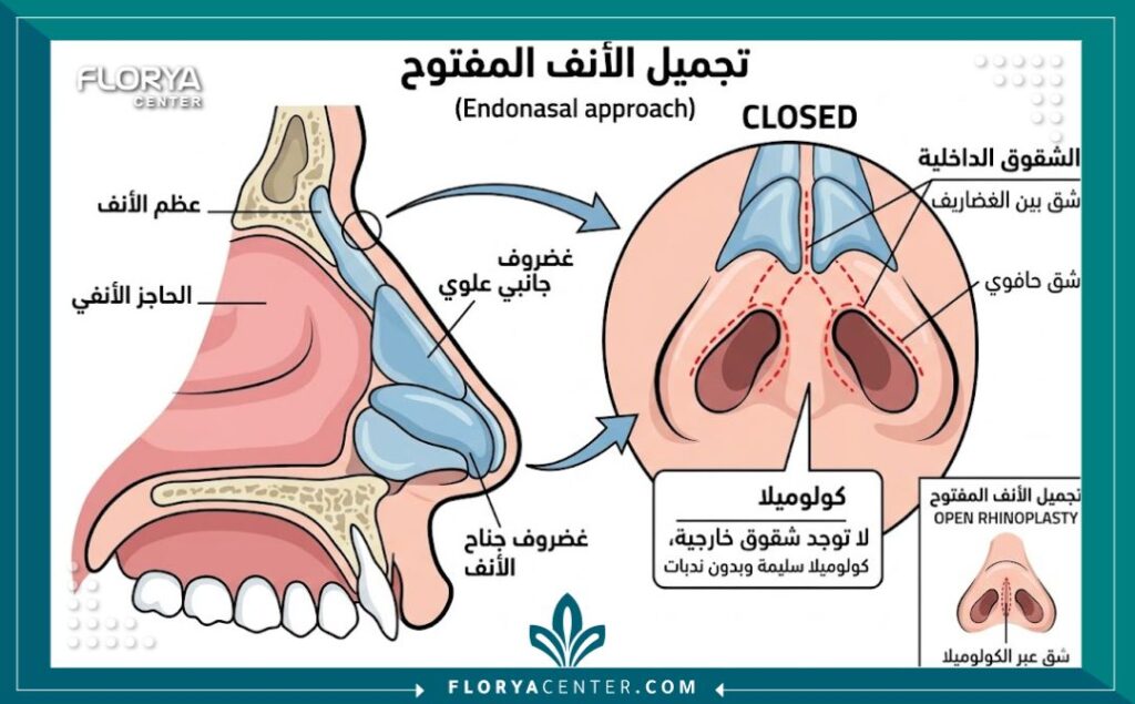 رسم تشريحي طبي يوضح تقنية عملية تجميل الأنف المغلقة وكيفية إجراء الشقوق الجراحية المخفية داخل فتحات الأنف بدون أثر خارجي.
