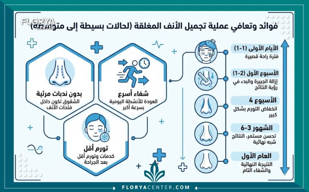 إنفوجرافيك يوضح مميزات جراحة الأنف المغلقة للحالات البسيطة والمتوسطة ومراحل التعافي السريع مقارنة بالجراحة المفتوحة.