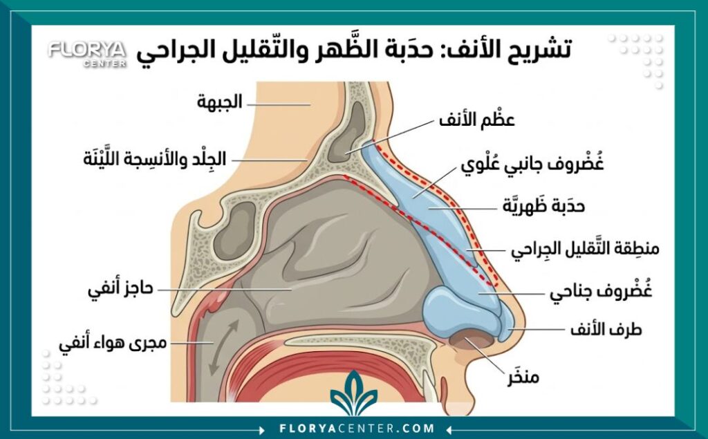 رسم توضيحي طبي يظهر تشريح عظمة الأنف البارزة والمنطقة المستهدفة بالإزالة أثناء الجراحة.