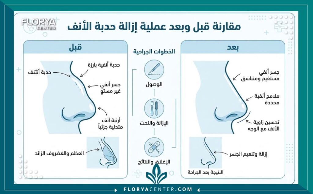 إنفوجرافيك يقارن بين شكل الأنف قبل وبعد عملية تجميل الأنف وإزالة العظمة البارزة.