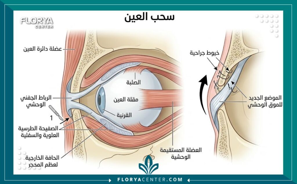 مخطط طبي يوضح تشريح سحب العين والتدخل الجراحي لتعديل الرباط الجفني الوحشي (Canthoplasty).