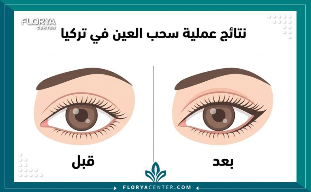 مقارنة انفوجرافيك قبل وبعد عملية سحب العين لتجميل العيون اللوزية (Almond Eyes).