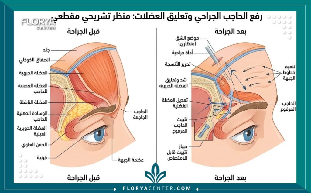 رسم توضيحي طبي ثلاثي الأبعاد يظهر تشريح عضلات الجبهة وآلية عملية رفع الحاجب جراحيا.