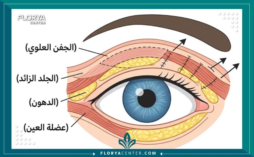  رسم تخطيطي طبي يوضح تشريح الجفن والمناطق المستهدفة في عملية قص الجفون العلوي والسفلي للتخلص من الترهلات.
