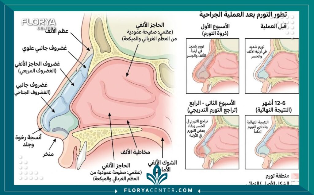 رسم توضيحي طبي لتشريح الأنف يوضح أماكن التورم وكيفية تعافي الأنسجة بعد الجراحة.