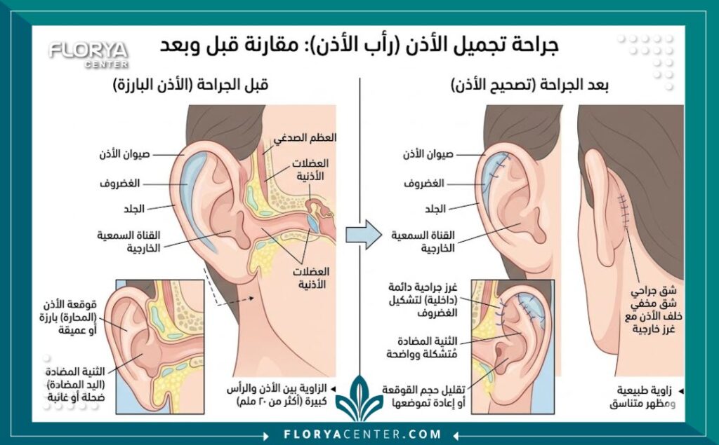 رسم توضيحي طبي يوضح تشريح الأذن وكيفية تعديل غضاريف الأذن البارزة جراحياً.