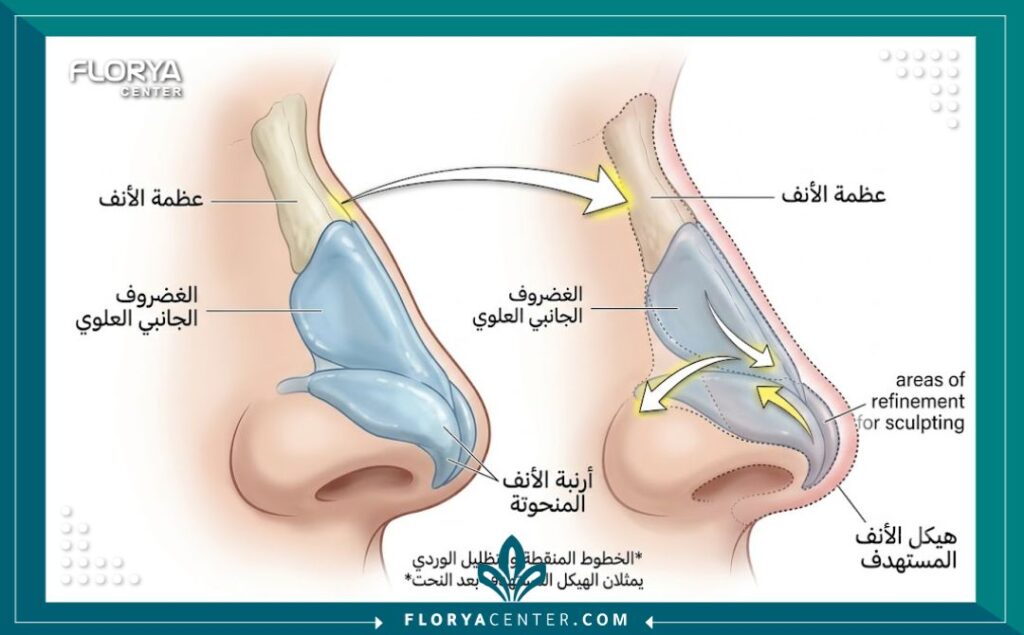 نحت الأنف في تركيا 2 رسم بياني طبي يوضح التشريح الداخلي للأنف والمناطق المستهدفة في عملية نحت الأنف في تركيا لتحقيق حواف دقيقة.