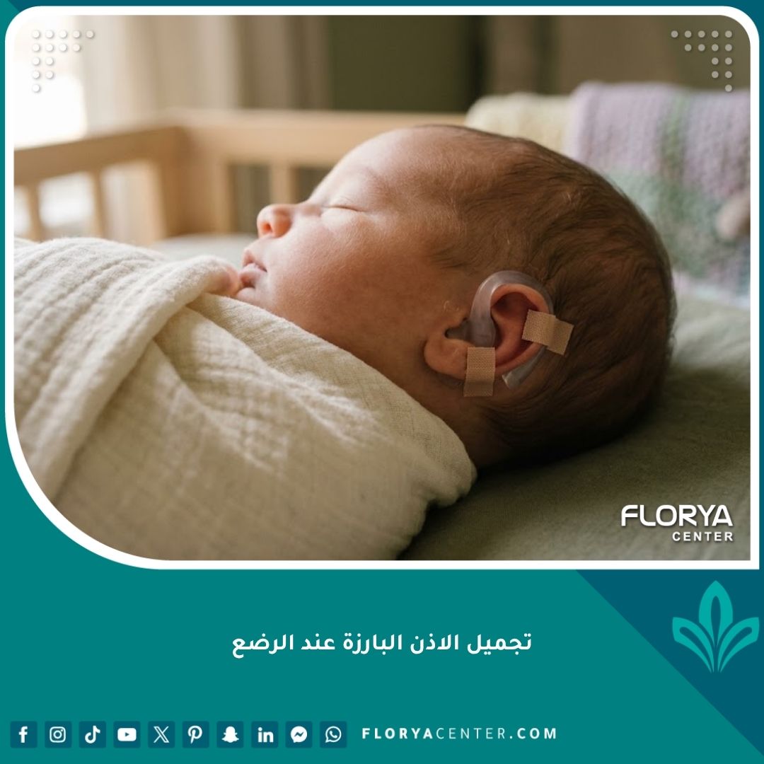 طفل رضيع نائم بسلام يرتدي قالب سيليكون لتقويم الأذن البارزة بدون جراحة، علاج الأذن الخفاشية لحديثي الولادة بأمان.